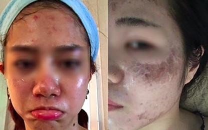 Đau đớn ê chề vì trót lăn kim làm đẹp da mặt ảnh 1