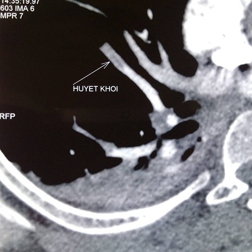 tắc động mạch phổi
