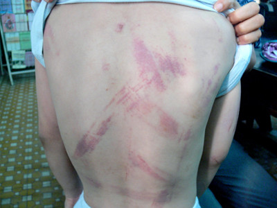 Những vết đòn roi trên thân thể cháu Bảo. Những vết đòn roi trên thân thể cháu Bảo