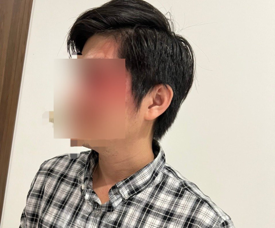 Thương tích trên mặt nạn nhân sau khi bị hành hung.