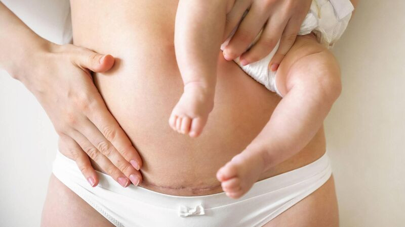 Vết rạn da là một trong những vấn đề thường gặp sau sinh, đặc biệt là đối với những phụ nữ tăng cân nhanh chóng trong thai kỳ.