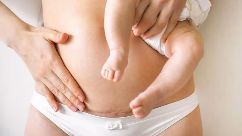 Vết rạn da là một trong những vấn đề thường gặp sau sinh, đặc biệt là đối với những phụ nữ tăng cân nhanh chóng trong thai kỳ.