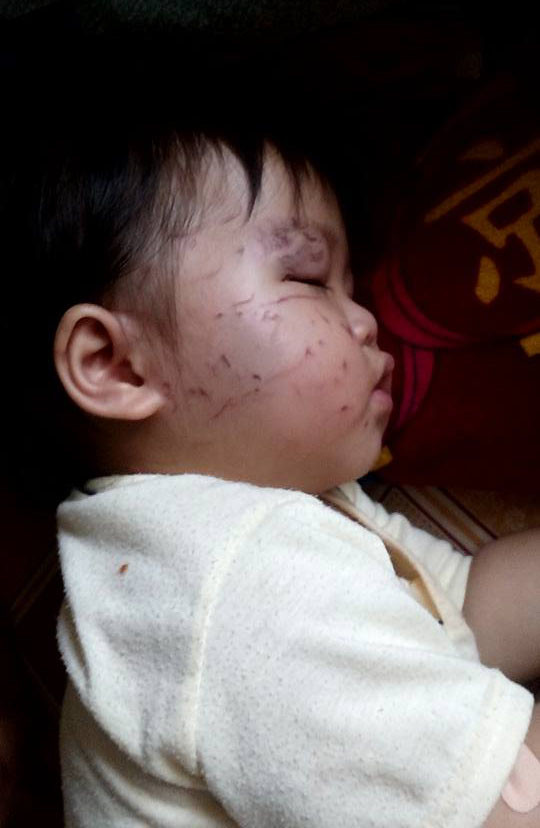 Bé 11 tháng tuổi bị bạn cắn, cào nát mặt ở nhà trẻ ảnh 2