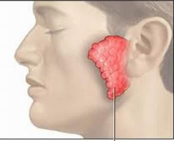 Cần phân biệt rõ quai bị và viêm tuyến nước bọt