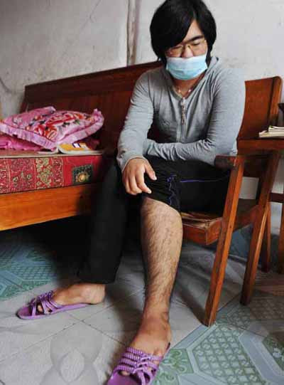 Chân tay của Nana cũng mọc đầy lông. Ảnh: Rex Features