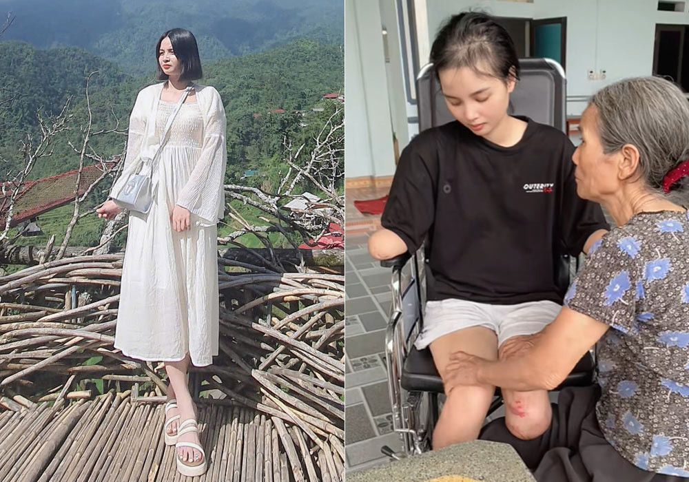 Nga phải cắt bỏ tứ chi vì cơn bạo bệnh. Ảnh: NVCC