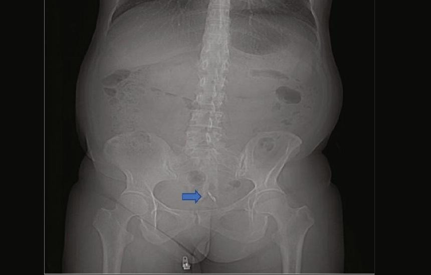 Vòng tránh thai được phát hiện trong bàng quang người phụ nữ