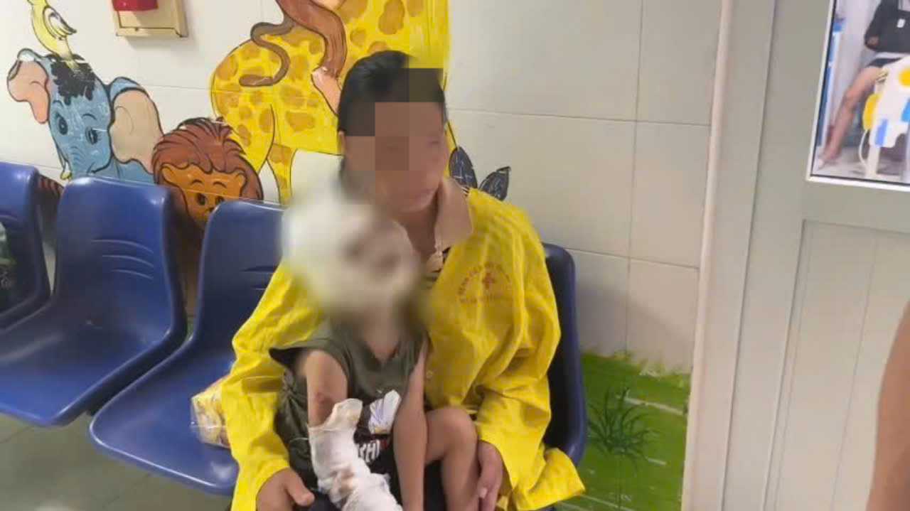 Bệnh nhi D bị bỏng chủ yếu vùng mặt Bệnh nhi D bị bỏng chủ yếu vùng mặt