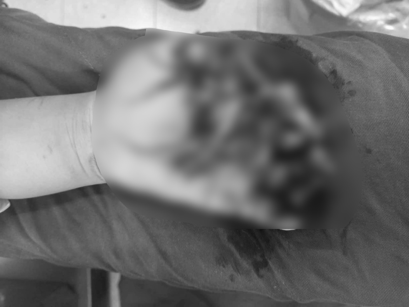 Bàn tay nạn nhân bị thương nghiêm trọng sau vụ nổ. Bàn tay nạn nhân bị thương nghiêm trọng sau vụ nổ.