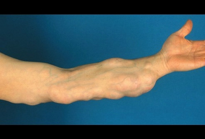  Hội chứng lipomas gia đình xảy ra ở người trong độ tuổi trung niên, không hạn chế phạm vi khuếch tán mỡ. Trong ảnh: nhiều lipomas trên cánh tay một bệnh nhân nam 50 tuổi