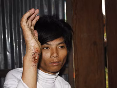 Người rừng Đinh Văn Diết với vết thương lở loét ở tay . Ảnh: Nguyễn Thành Người rừng Đinh Văn Diết với vết thương lở loét ở tay