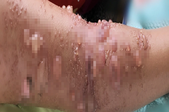 Một trường hợp da trợt rỉ dịch, lở loét vì bị bỏng sứa (Ảnh: BV).