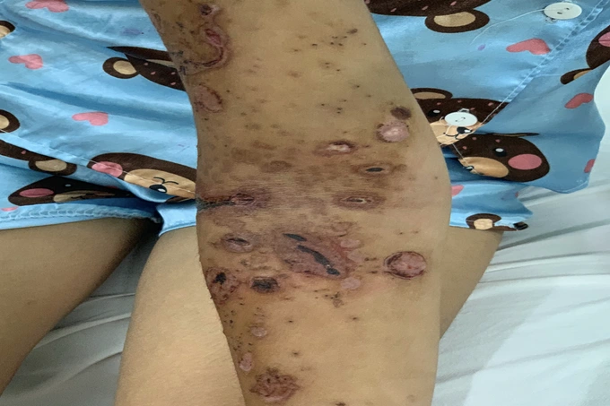 Khi bị sứa biển gây bỏng, người dân không đắp lá cây, chà cát vì có thể sẽ làm vết thương nhiễm trùng nặng nề hơn (Ảnh minh họa: BV).