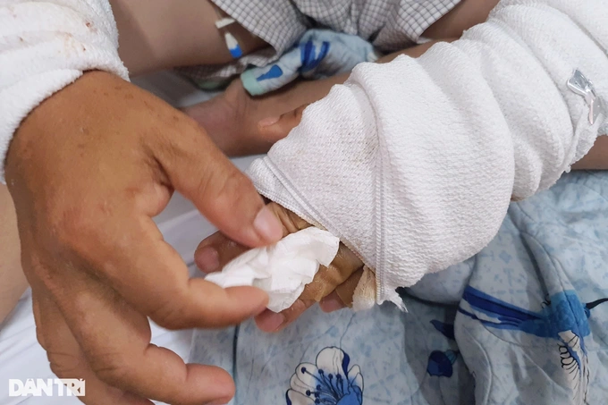 Hóa chất bắn lên, ăn mòn da tay, chân và nhiều vị trí trên cơ thể anh N. (Ảnh: Hoàng Lê). Hóa chất bắn lên, ăn mòn da tay, chân và nhiều vị trí trên cơ thể anh N. (Ảnh: Hoàng Lê).