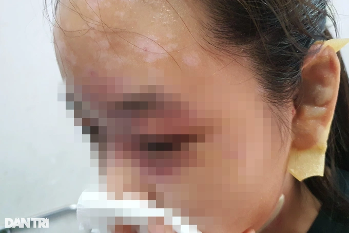 Con gái anh N. bị bỏng sâu vùng mặt, có thể để lại sẹo (Ảnh: Hoàng Lê). Con gái anh N. bị bỏng sâu vùng mặt, có thể để lại sẹo (Ảnh: Hoàng Lê).