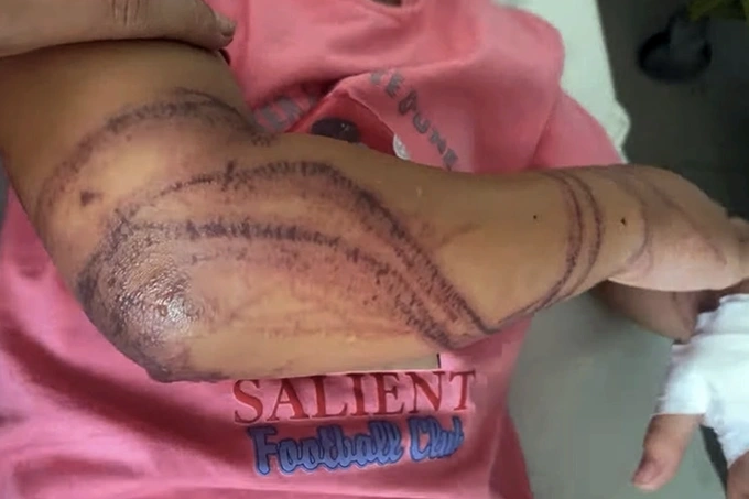 Bé gái đi tắm biển bị sứa làm bỏng da (Ảnh: Minh Châu).