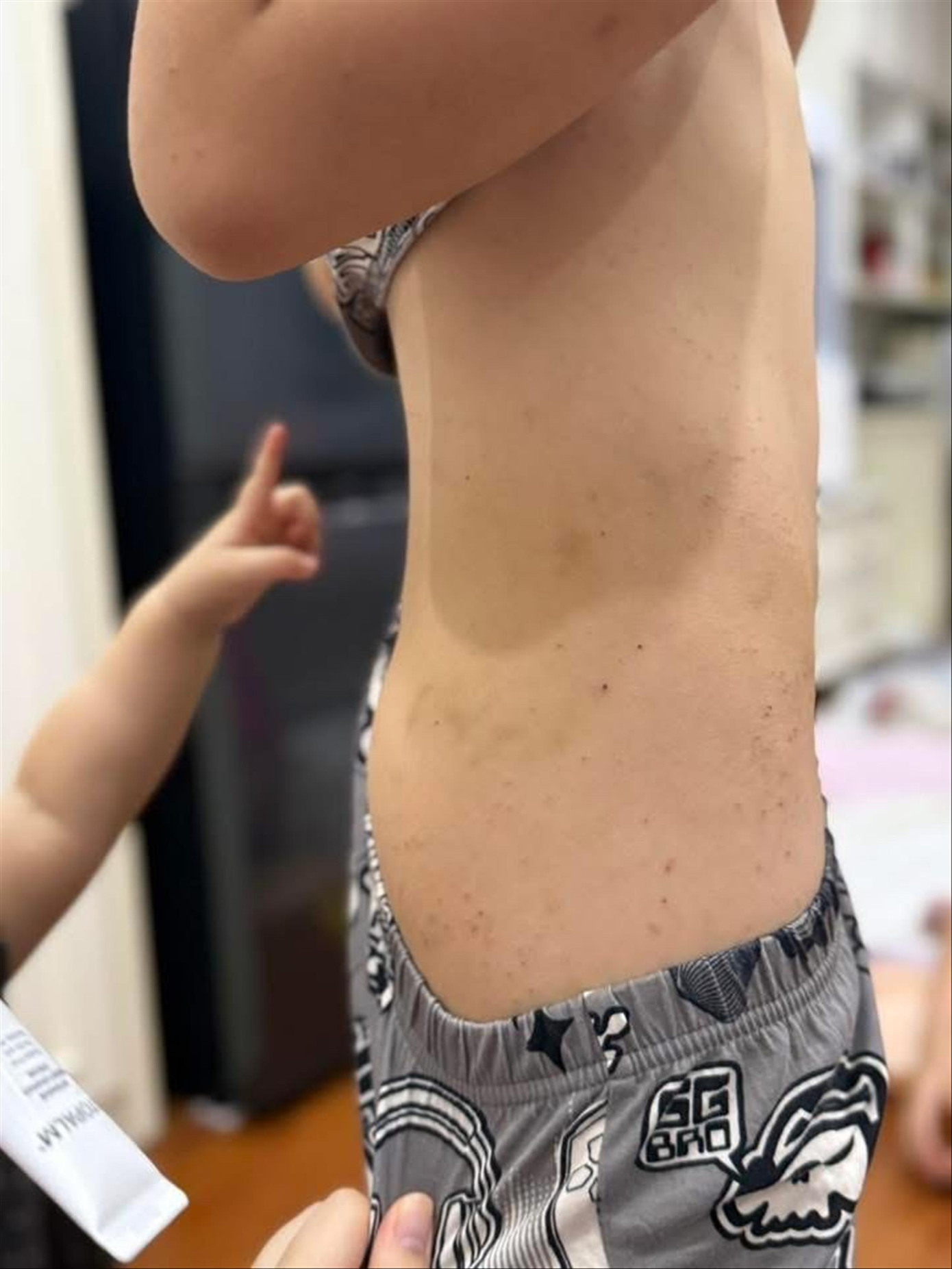 Những vết nổi mẩn ngứa trên người con trai chị Chử Ngọc Ly Những vết nổi mẩn ngứa trên người con trai chị Chử Ngọc Ly