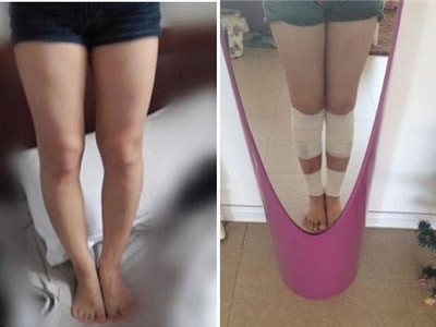 Đôi chân cô gái trước và sau khi nắn chỉnh
