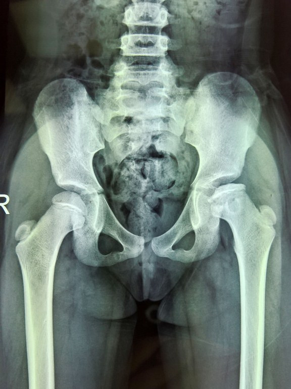 Con hoại tử xương đùi vì cha mẹ chủ quan ảnh 2