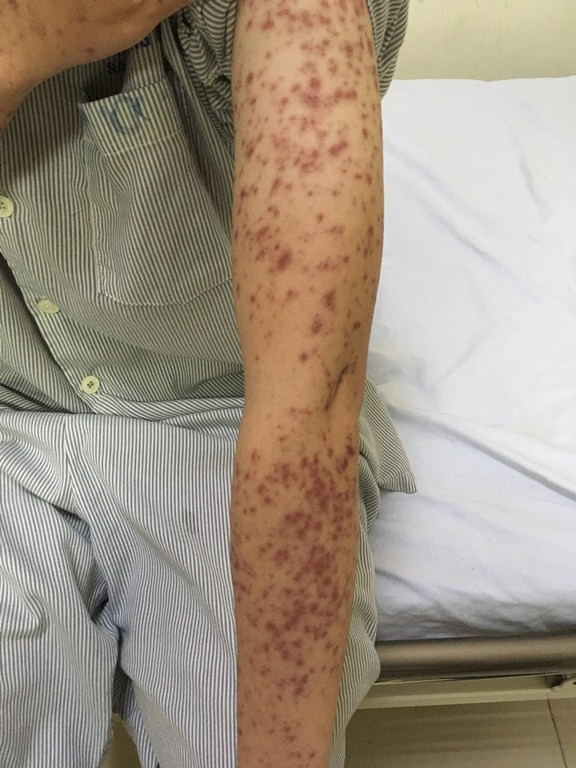 Biến dạng khuôn mặt vì tự ý dùng thuốc đau đầu ảnh 1