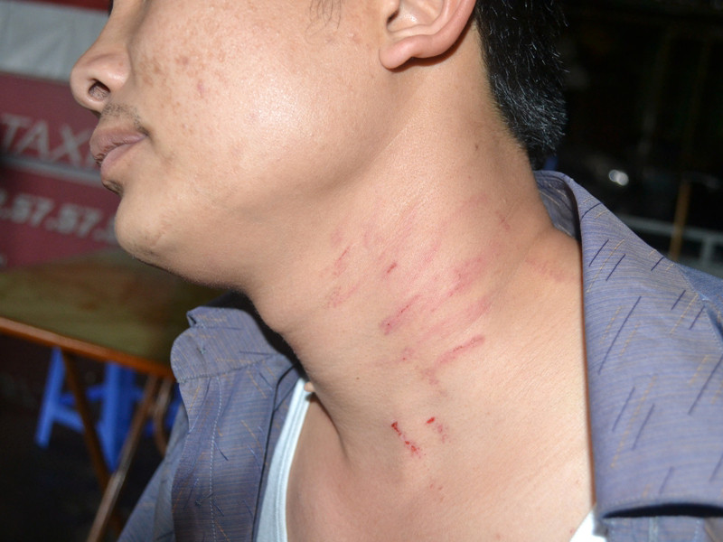 Vết thương trên cổ anh Trọng do bị nhà xe hành hung. Ảnh: Tuấn Nguyễn