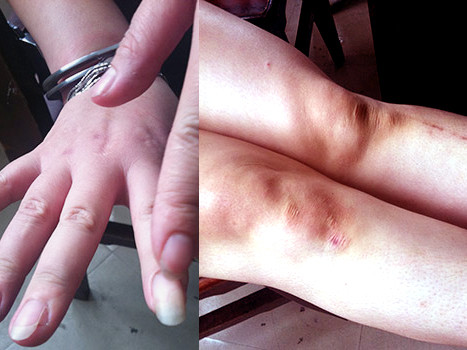 Ngón tay bị cha dượng chém (ảnh trái) và những vết thương do bị cha dượng đánh đập (ảnh phải)