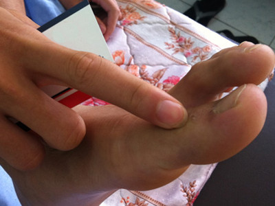 Dấu chuột cắn còn in lại trên chân của một người dân. Ảnh: Thiên Chương (VnExpress)