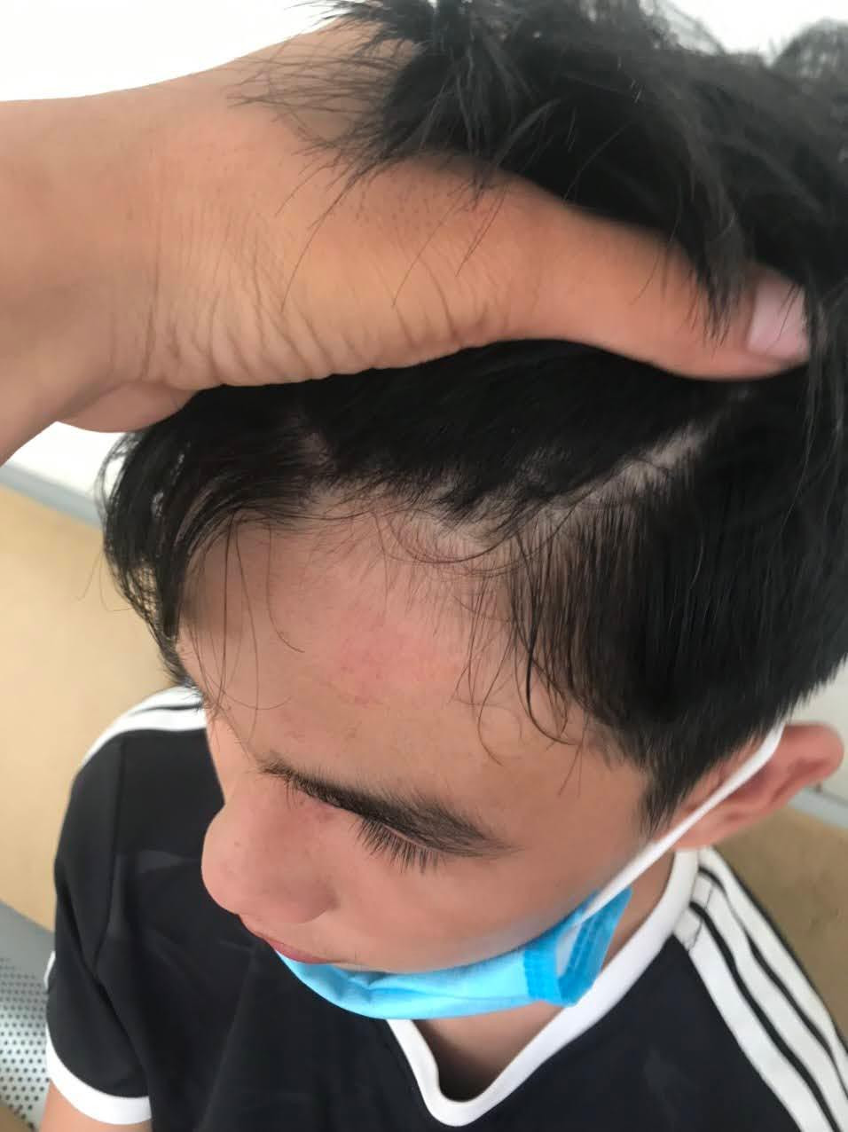 Cháu Bảo sau khi bị đánh (Ảnh gia đình cung cấp)