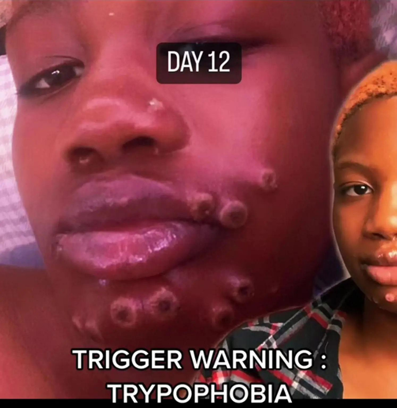 Camille Seaton là người phụ nữ đầu tiên ở Mỹ mắc bệnh đậu mùa khỉ. Camille Seaton là người phụ nữ đầu tiên ở Mỹ mắc bệnh đậu mùa khỉ.