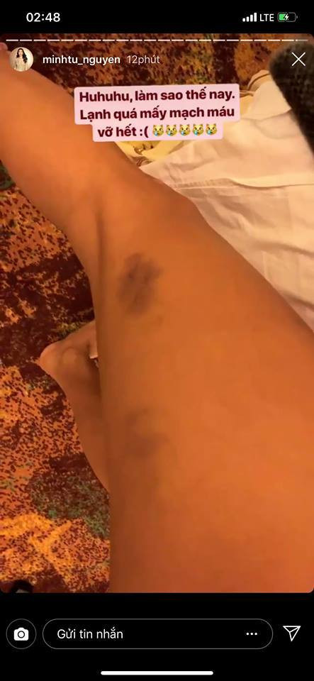 Minh Tú bị vỡ mao mạch vì trời quá lạnh khi thi Hoa hậu siêu quốc gia ảnh 2