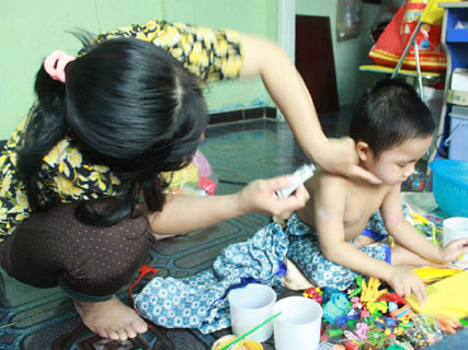 Mỗi lần bôi kem chống sẹo cho con, chị Thúy lại ứa nước mắt. Ảnh: Bee.net.