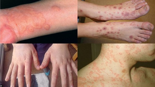  Vợ chồng thân mật là Thúy lại có hiện tượng nổi mề đay khắp người, toát mồ hôi. Ảnh minh họa. 