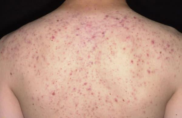 Bệnh nhân bị ngộ độc thuốc tê khi đến Spa trị mụn Bệnh nhân bị ngộ độc thuốc tê khi đến Spa trị mụn