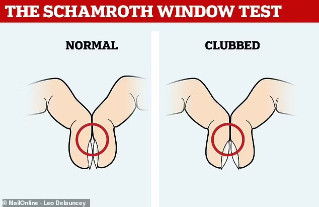 Người khỏe mạnh thường có một khe hở hình kim cương (hình thoi) giữa các móng tay khi họ ép chúng lại với nhau. Nếu khe hở không xuất hiện (ngón tay dùi trống) đó có thể là dấu hiệu của ung thư phổi. Đồ họa: Mail Online