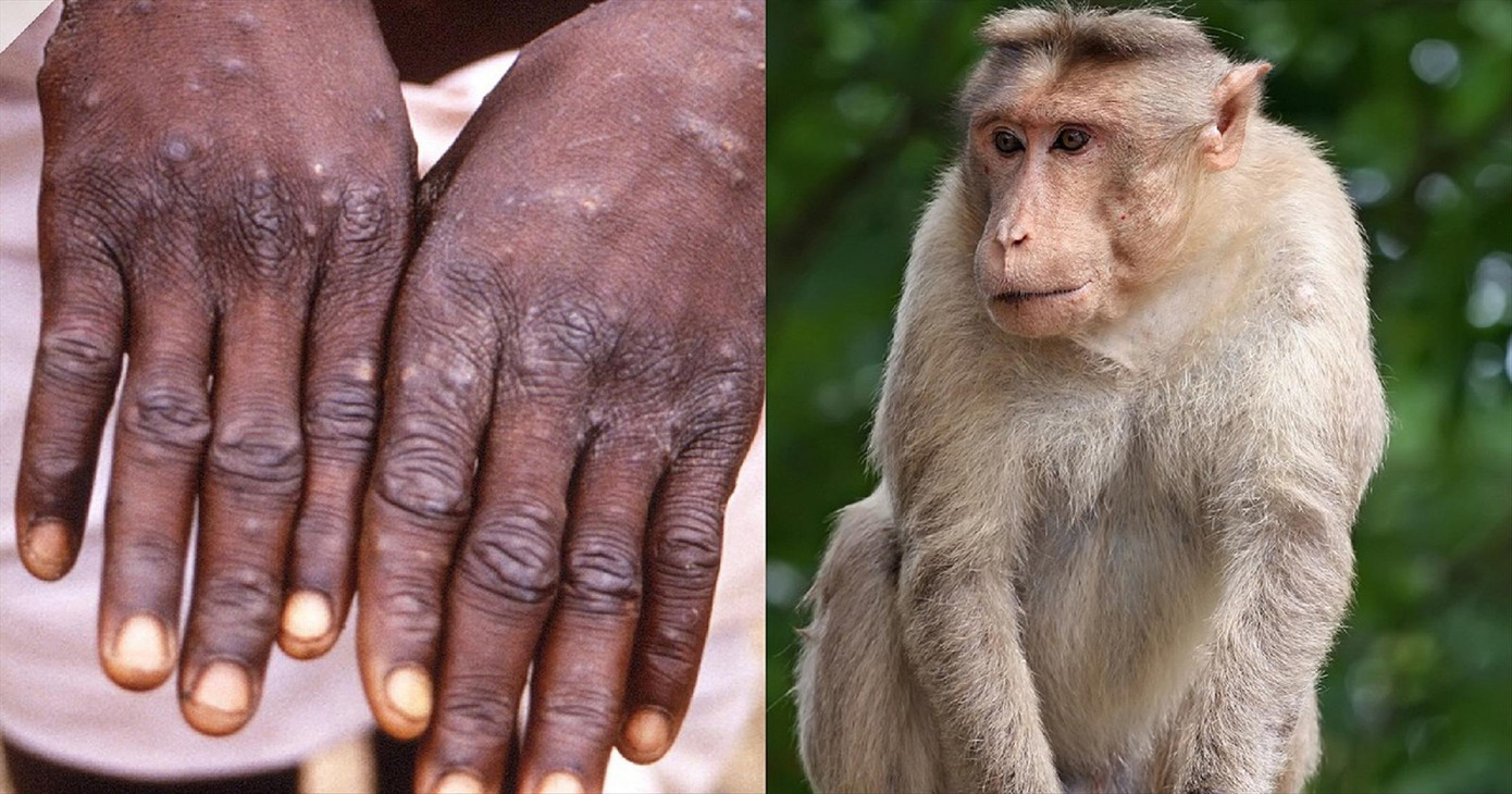 Bệnh đậu mùa khỉ đã xuất hiện ở 19 quốc gia trên toàn cầu. Ảnh minh họa