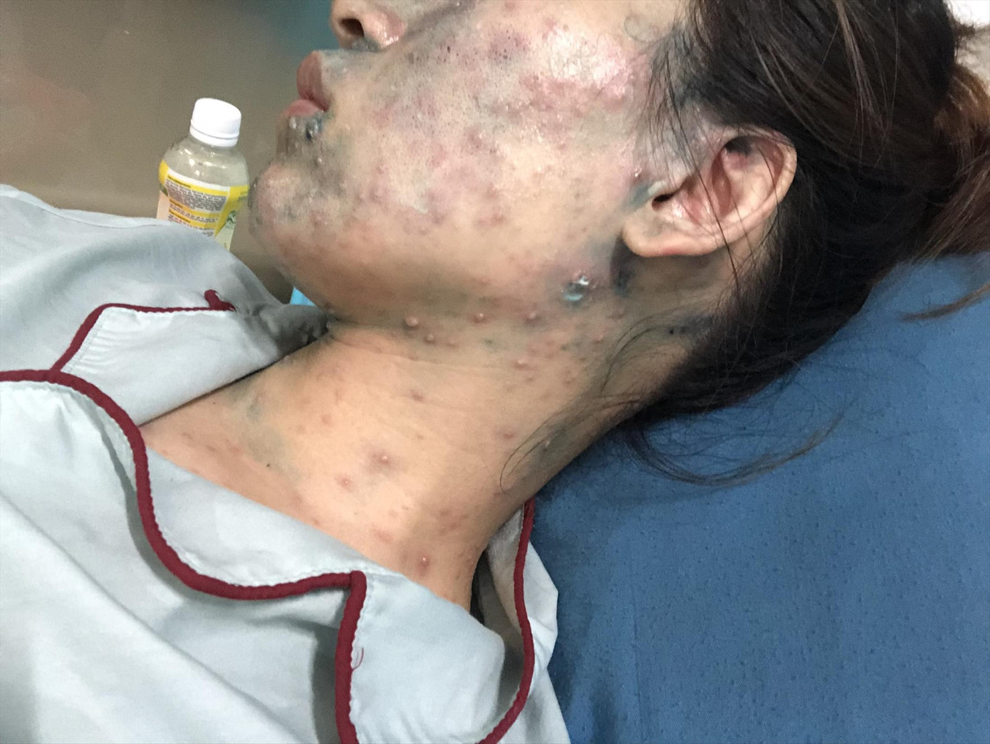 Thai phụ mắc thủy đậu bị bội nhiễm Thai phụ mắc thủy đậu bị bội nhiễm