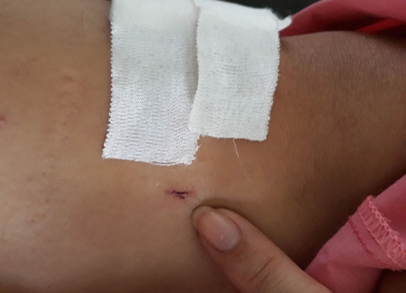 Khoan nhầm cẳng chân khi bệnh nhân gãy đốt sống ngực ảnh 1