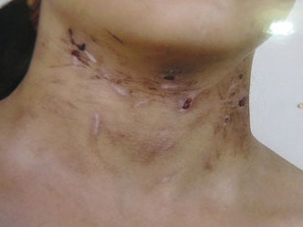 Những vết tổn thương trên cổ bé T. . Những vết tổn thương trên cổ bé T.