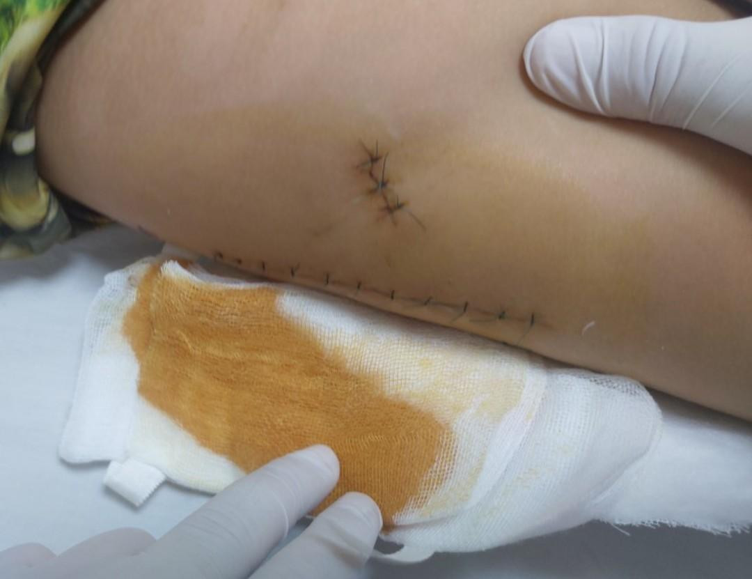 Vết thương sau khi được xử trí cầm máu chảy trong cơ. Ảnh: Bệnh viện cung cấp Vết thương sau khi được xử trí cầm máu chảy trong cơ. Ảnh: Bệnh viện cung cấp