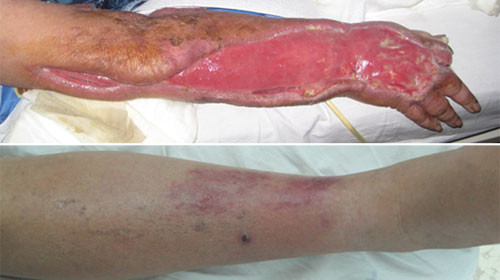 Vết thương tay hết nhiễm trùng có thể ghép da và cẳng chân sưng đỏ sau khi bị chân chống xe máy quẹt trúng. Ảnh do bệnh viện cung cấp