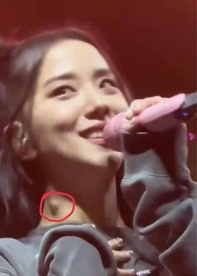 Jisoo nổi hạch lớn ở cổ. Ảnh: HK01.