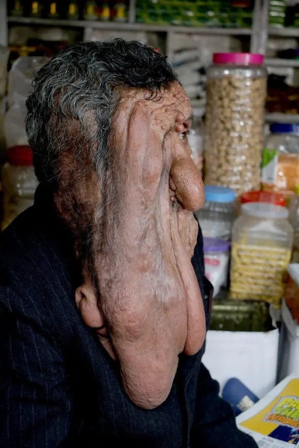 Khối u chảy xệ, che hết nửa tai và mặt của người đàn ông