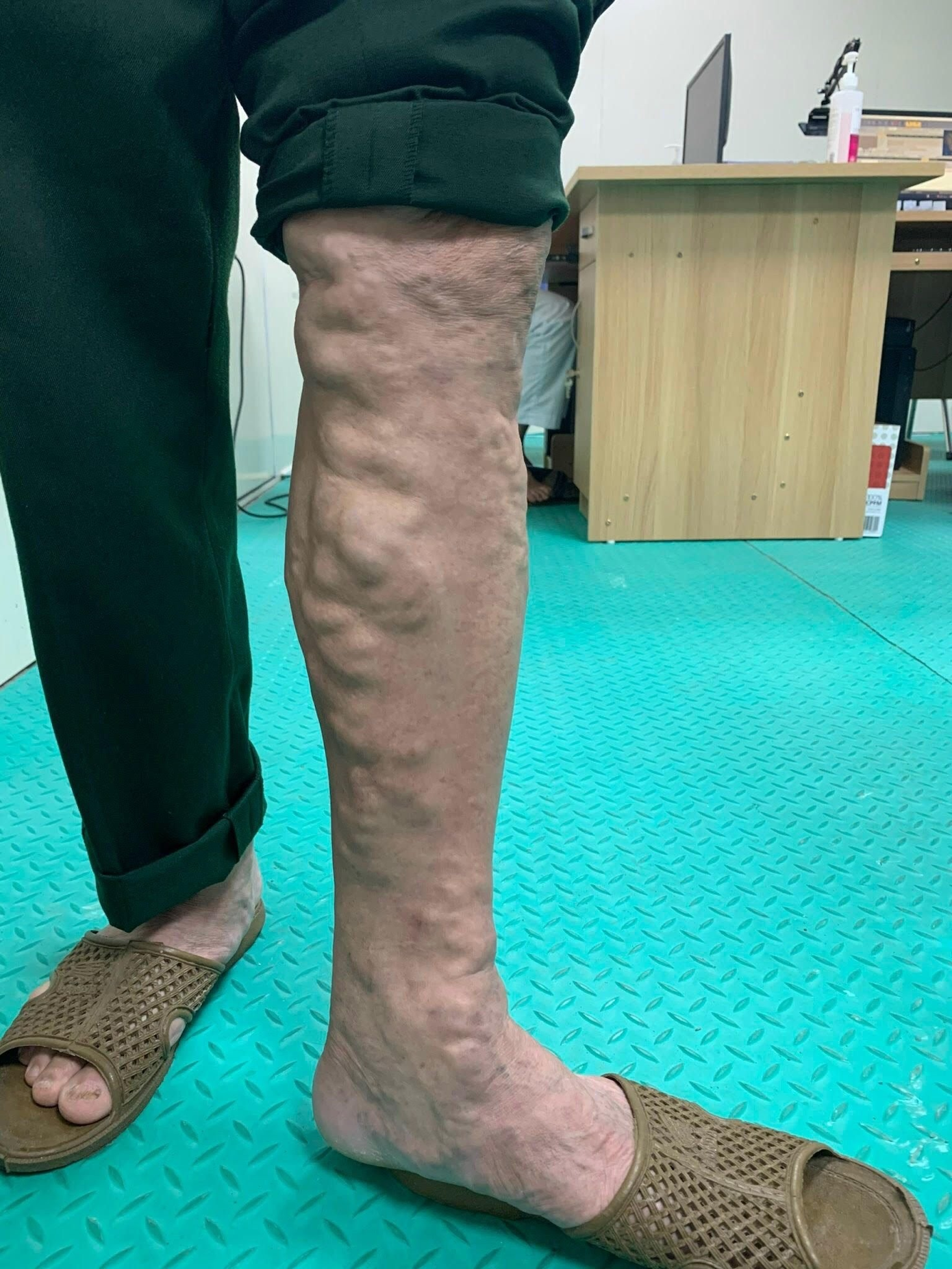 Dấu hiệu nặng của suy giãn tĩnh mạch Dấu hiệu nặng của suy giãn tĩnh mạch