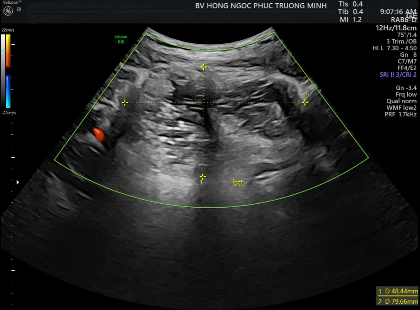 Hình ảnh siêu âm cho thấy khối u kích thước 48*80mm tại buồng trứng trái.