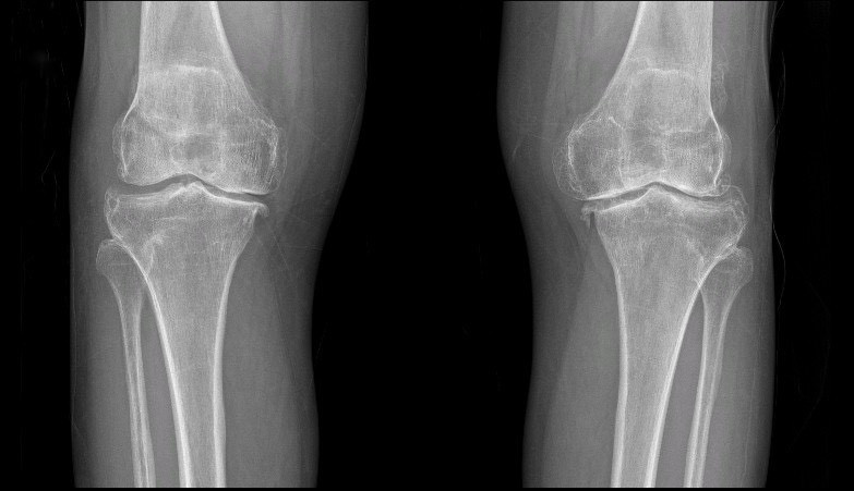 Hình ảnh thoái hóa khớp gối trên phim chụp Xquang Hình ảnh thoái hóa khớp gối trên phim chụp Xquang
