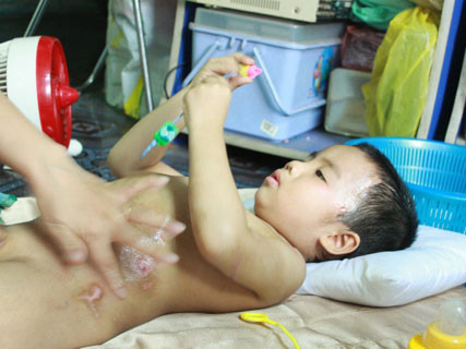 Sau hơn 1 tháng điều trị, trên người cháu Vinh vẫn mang những vết thương kinh hoàng. Ảnh: Bee.net.