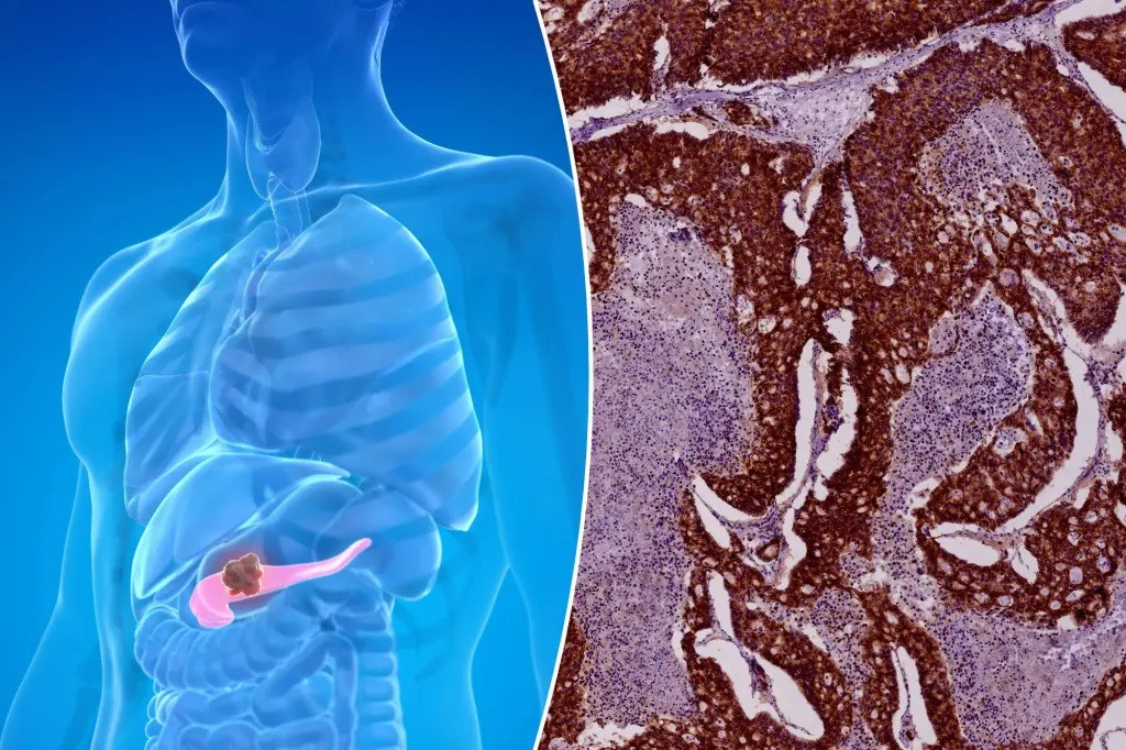 Ung thư tuyến tụy có tỷ lệ tử vong cao nhất trong số các bệnh ung thư chính ở Mỹ và chiếm 3% tổng số ca tử vong do ung thư.