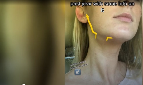 Trong khi mát xa mặt, Bender đã phát hiện ra khối u ở xương quai hàm và đi khám bác sỹ ngay lập tức.