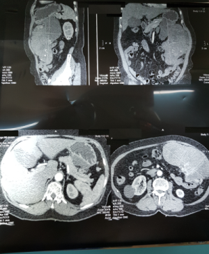 Ngỡ bụng to do tăng cân, người phụ nữ suýt chết vì khối u khủng ảnh 1