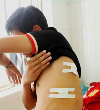 Em Tài với vết thương trên người